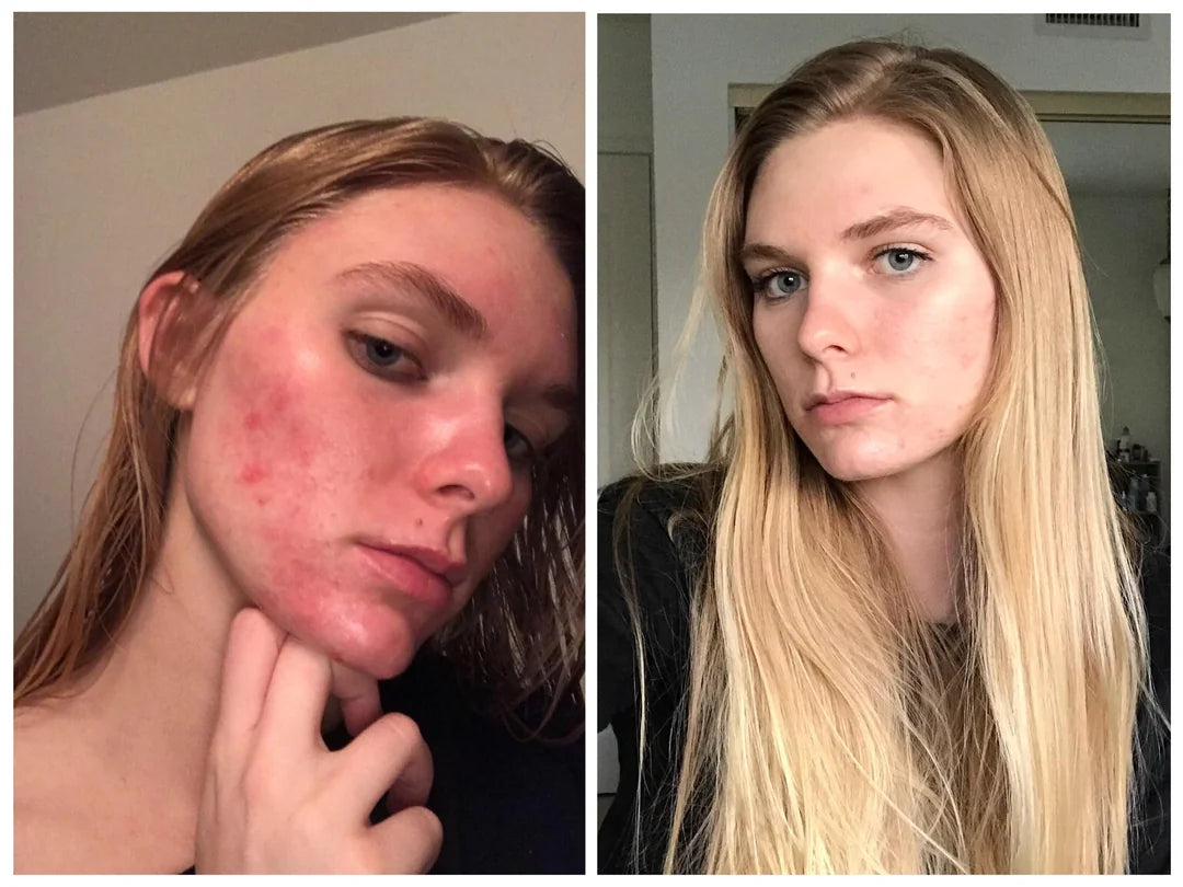 The Ordinary Niacinamide 10 Zinc 1